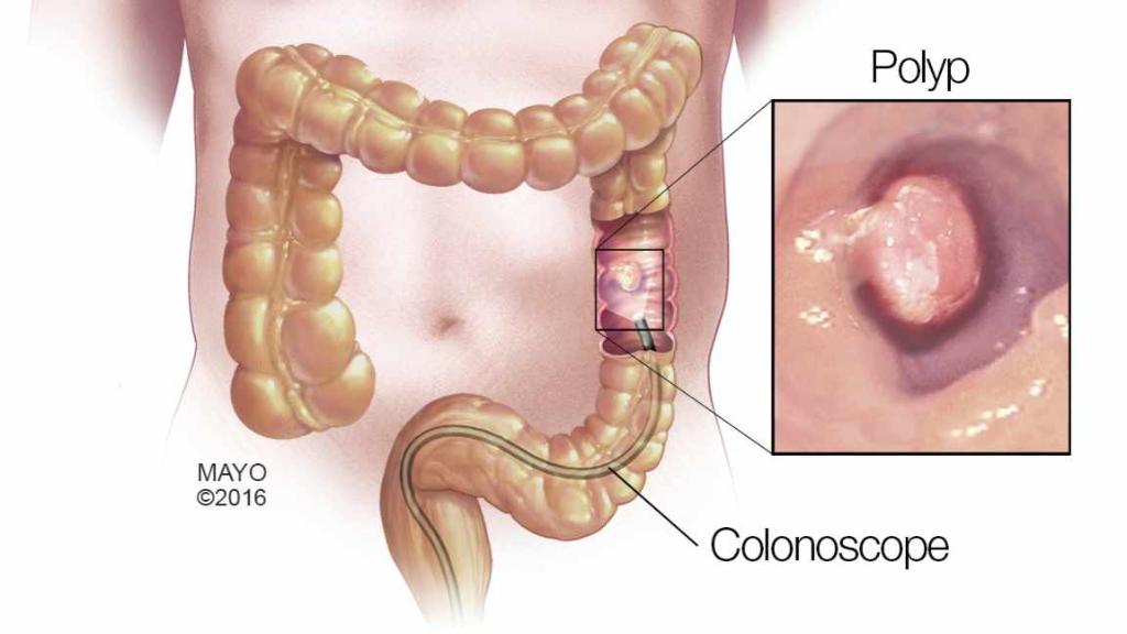 Como reducir el metano en el intestino