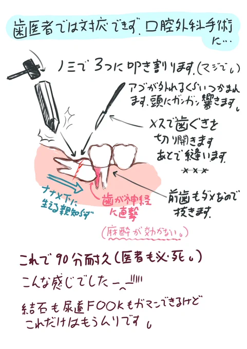 @kcosmos22 それは幸運です〜?私は3回抜いたんですが他の2回は特に…状況が最悪だったこの時だけは1.5時間の手術中、呼吸困難起こすほど激痛を我慢しまくって術後は疲労でまともに歩けず、点滴を打たれて眠っていました…もうあれだけはホントに二度とやりたくありませんー? 