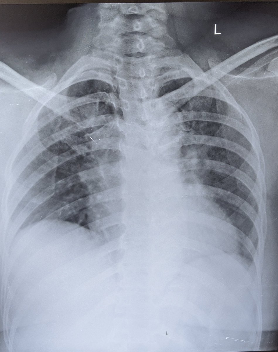 Any comments on this X Ray? #MedTwitter  #FOAMed  #FOAMrad