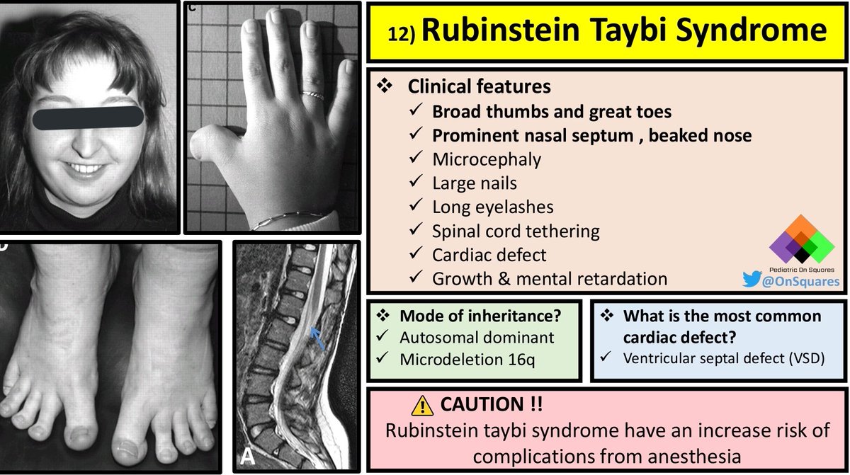 Rubinstein-Taybi syndrome: Treatments and life expectancy