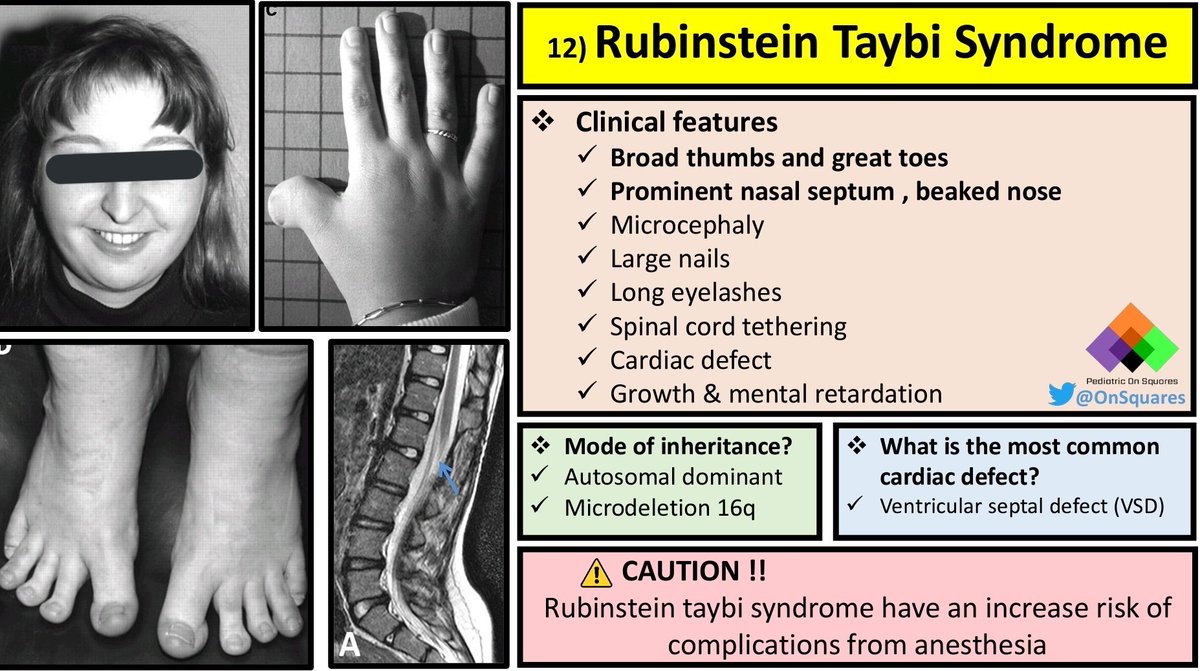 Facial features of Rubinstein-Taybi syndrome