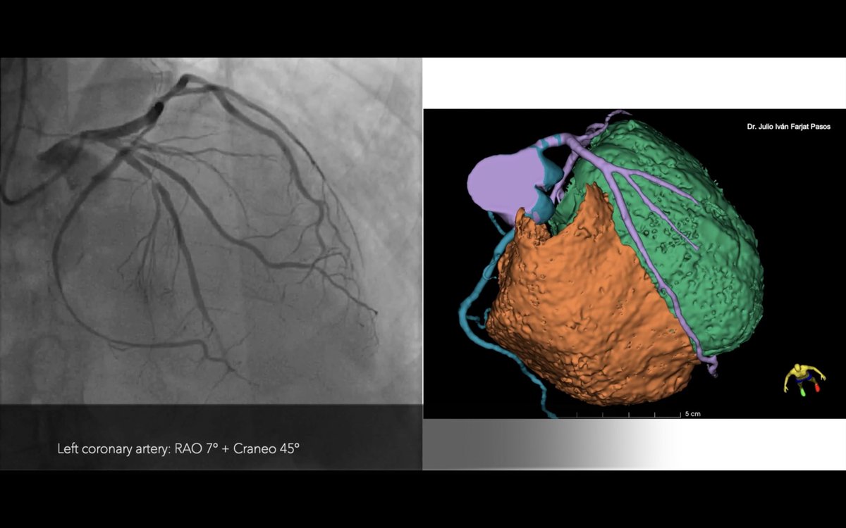Julio_Farjat's tweet photo. One of the tricky parts when beginning in the analysis of invasive coronary angiographies is to really understand "what it is, where it is and where it goes", specially starting the CV fellowship.

We think this can be useful!

https://t.co/hPCuQFndHE https://t.co/Xc1nnliqFY