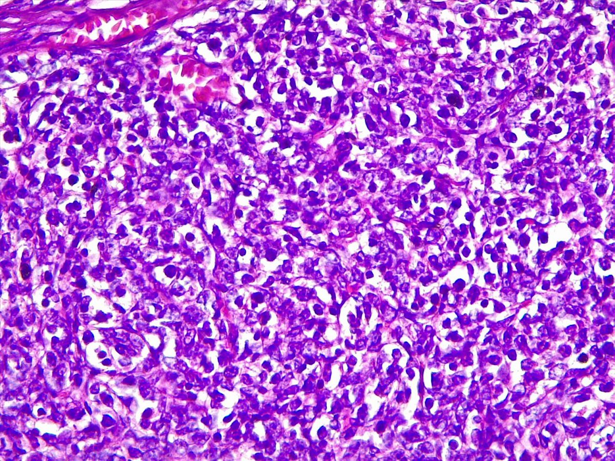 path4ever's tweet photo. Hi dear friends I need ur opinion for sub typing this thymoma 🙏🙏from right lobe 65y F Masaoka stage II clinically #pathology #patholigist #mediastinum @yro854 @smlungpathguy @DrGeeONE @D4L14H @TheKarenPinto @SamKhader 1/3 https://t.co/I47PAM7Mbl