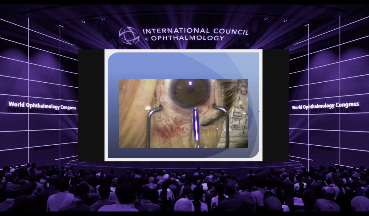 CynthiaHMiranda's tweet photo. To finish Sunday’s live sessions. DMEK techniques: a virtual wetlab sponsored by Eversight. #DMEK #Eversight @EversightVision #WOC2020 https://t.co/HEGqn6wfoa