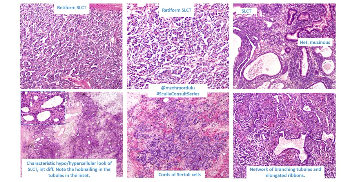 RES: This tumor shows most of the patterns of SLCT. It has large het elements in the form of intestinal type glands and large retiform component. Some of the tubular structures are lined by hobnail cells, which we have seen before.  #ScullyConsultSeries  #GynPath  #GynPathQuiz