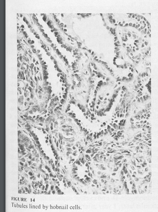 The "retiform" pattern derives from the resemblance to "rete testis".SLCT peaks at 25 years, retiform occurs in younger (15 years)SLCT has androgenic manifestations up to 50%; less common if retiform (25%)  #GynPath  #GynPathQuizImages from:  https://pubmed.ncbi.nlm.nih.gov/6660351/&nbsp;