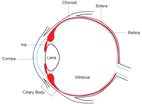 UM affects about 5/million, and about 3-5% of advanced melanomas in the US arise from the uveal tract (iris, ciliary body, choroid). Of these, iris is rarest + least aggressive, so we often call it “choroidal” melanoma. Get your dilated eye exams, folks!2/x