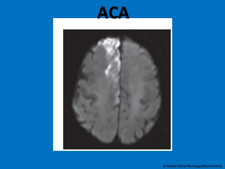 MRI w/ACA strokeRecall that homunculus=leg medial, arm superior/lateral, face most lateral So ACA stroke can cause contralateral leg>arm weakness &cognitive changesI’ve only seen a few ACA strokes but countless MCA, PCA strokes–perhaps the fluid dynamics/geometry—thoughts?