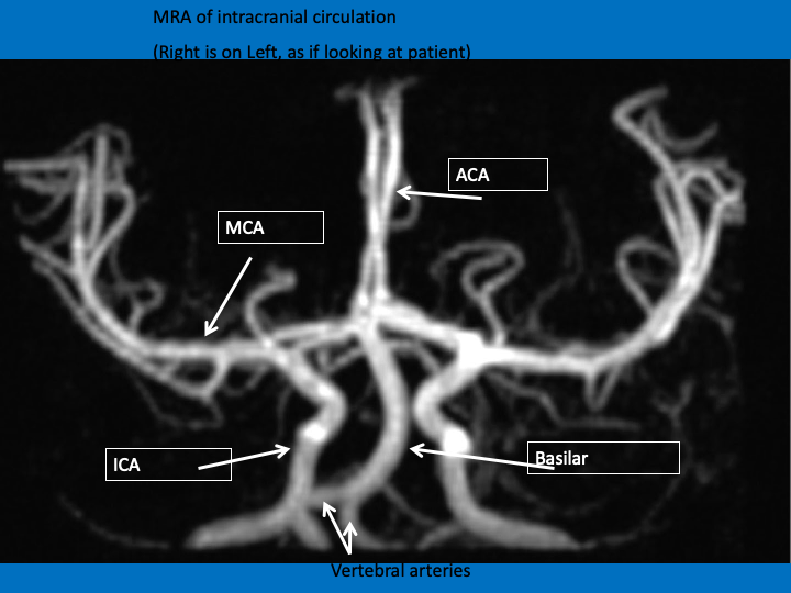 The posterior and anterior circulation are linked by the POSTERIOR COMMUNICATING arteries (Pcomms) and the ACAs by the ANTERIOR COMMUNICATING arteries (AComms). This makes a complete circle, the CIRCLE OF WILLISHere’s how we often see the cerebrovascular system: MRA