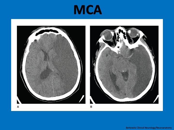 CT w/full territory MCA stroke. This will causeContralateral hemiplegia(motor ctx)/hemisensory loss (somatosensory ctx)/homonymous hemianopia (optic radiations)Language deficit (if left)/Neglect (if right)Strokes affecting just branches of MCA can cause lesser/fewer sx