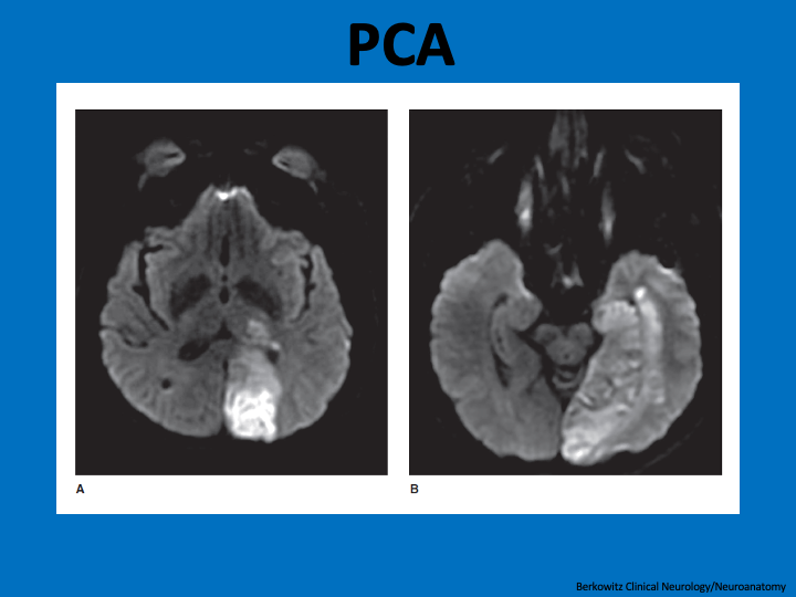 This MRI shows a PCA stroke:PCA strokes cause contralateral visual field deficits and can cause amnesia if hippocampus affected. Note how PCA includes inferior/medial temporal lobe and thalamus, not just visual cortex