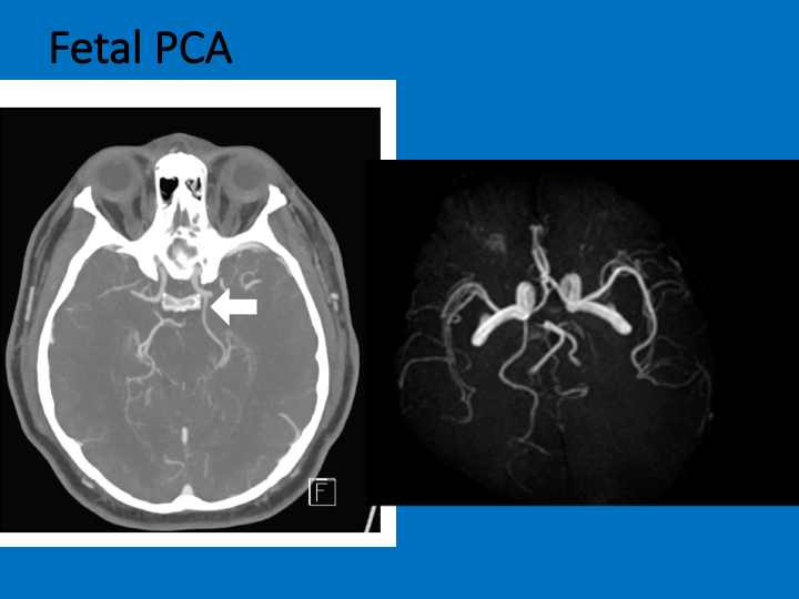 To close, Some gourmet vascular anatomy:FETAL PCA=normal variant of PCA coming off ANTERIOR circulationNo clinical relevance UNLESS PCA stroke on side of fetal PCA 2/2 severe carotid stenosis=would mean carotid symptomatic (normally could only be case w/ACA or MCA stroke)