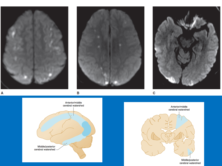 Watershed/borderzone=regions@ borders of territoriesACA/MCA MCA/PCA=most common We're taught borderzone strokes=hypotension mechanism But can be EMBOLIC: smallest possible emboli end up in the end-arterial territoriesFor discussion see  https://pubmed.ncbi.nlm.nih.gov/9823834/ 