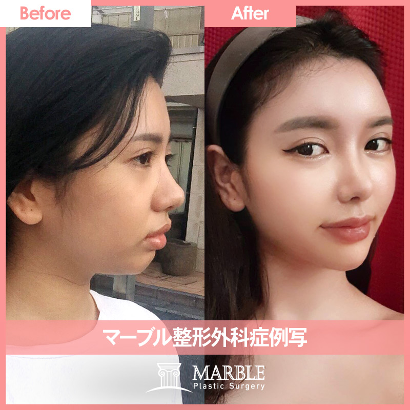 マーブル美容整形外科 最も女性らしい顔ラインにアップグレード 脂肪移植 鼻手術 顎先プロテーゼであなたの側面のラインを完成してください 手術及び相談のお問い合わせはこちらに T Co Gu2338oe8w 鼻手術 顎先プロテーゼ Eライン 輪郭 マーブル美容整形外科 最も女性らしい顔ラインにアップグレード 脂肪移植 鼻手術 顎先プロテーゼであなたの側面のラインを完成してください 手術及び相談のお問い合わせはこちらに T Co Gu2338oe8w 鼻手術 顎先プロテーゼ Eライン 輪郭