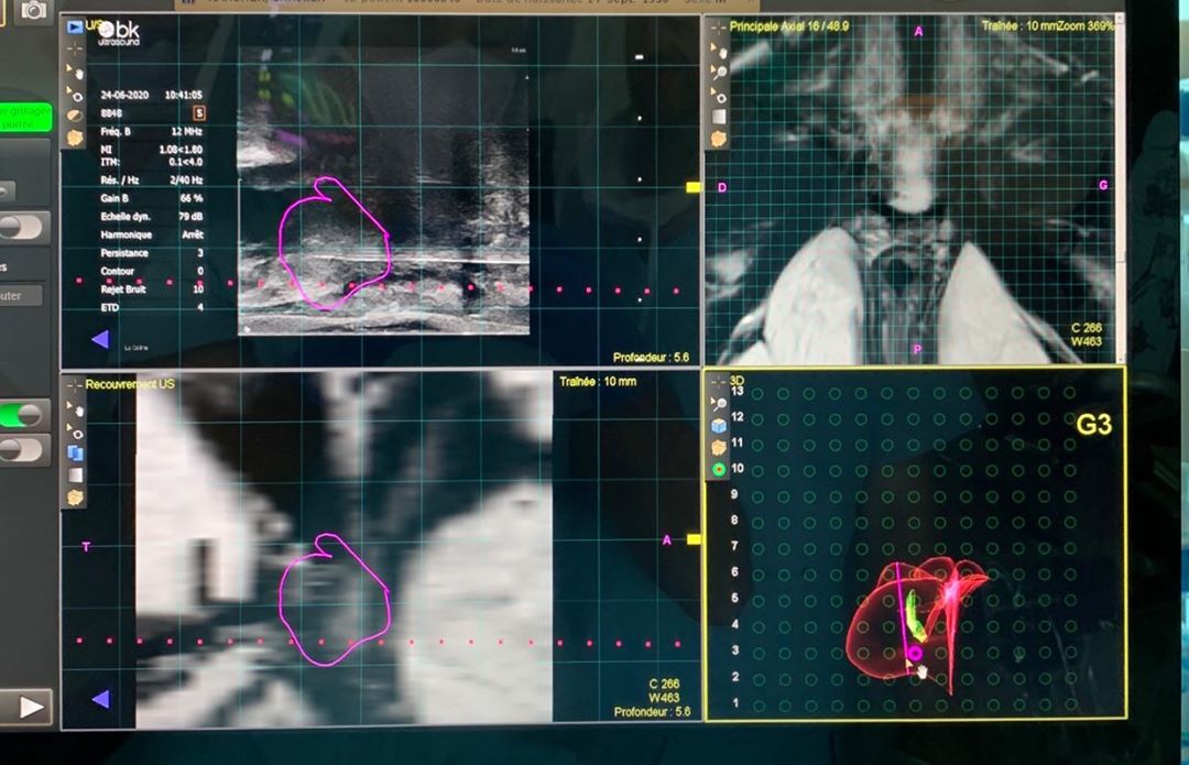 Traitement du #cancer de la #prostate avec laser avec les Drs Stefano Regusci et Martina Martins Favre #soractelite #echolaser #elesta #ProstateCancer