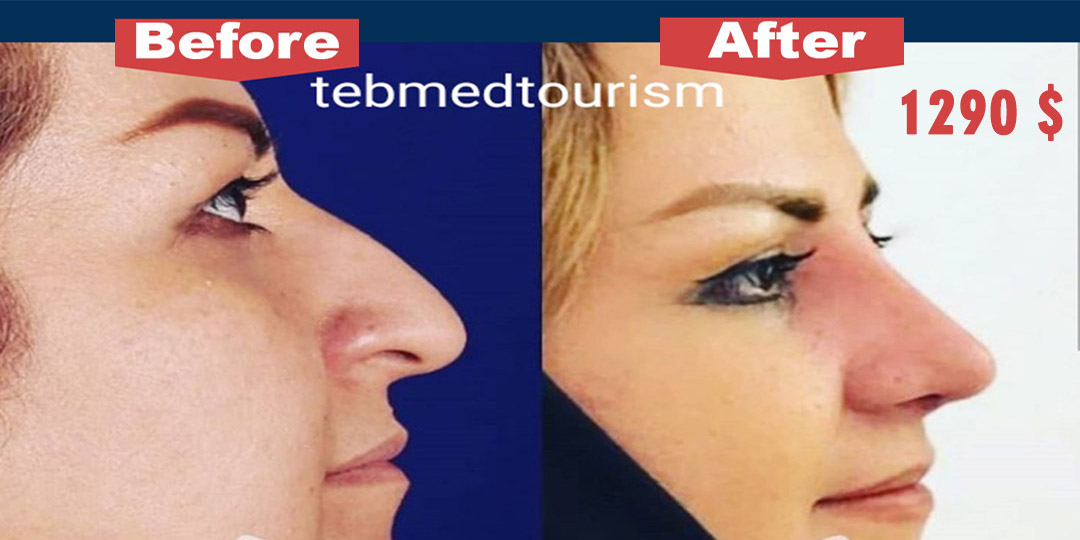TebMedTourism's tweet photo. Believe it or not, Tehran is the “#nose_job” capital of the world – with more procedures per person than even the home of Hollywood itself, LA.
Whatsapp: +989120985010
#rhinoplasty #septoplasty #cosmetic_surgery #cosmetic #health_tourism #medical_travel #treatment_in_iran https://t.co/36lGy7jyen