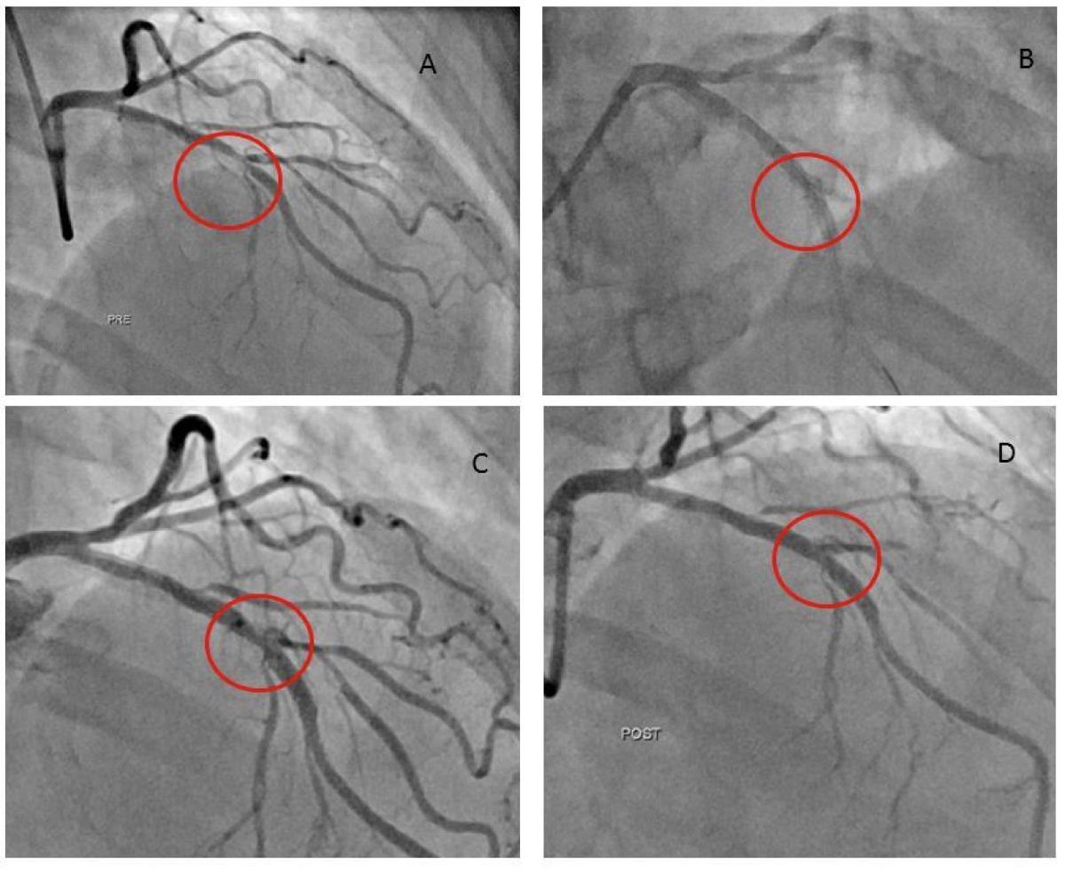"Outcomes of Excimer Laser-Contrast Angioplasty for Stent Under-Expansion" by <a href="/JohnNanMD/">John Nan</a> et al. #EAPCI bit.ly/2CsEUqU