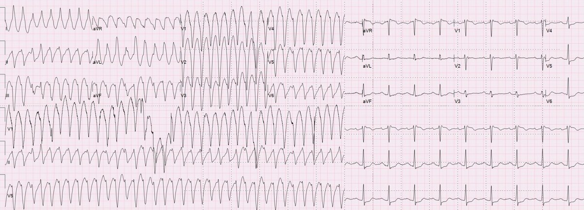 1st Take away point when treating tachycardia (& every patient (in  #EmergencyMedicine)) = Determine if clinically stable or unstable!  #cardiotwitter  #FOAMed  @alifarzadmd  @smithECGBlog  @EMS12Lead  @amalmattu  @ECGQuizzes  @ECGfan  @HedayatiMD  @ECGTeacher  @paramedickiwi  @Thind888