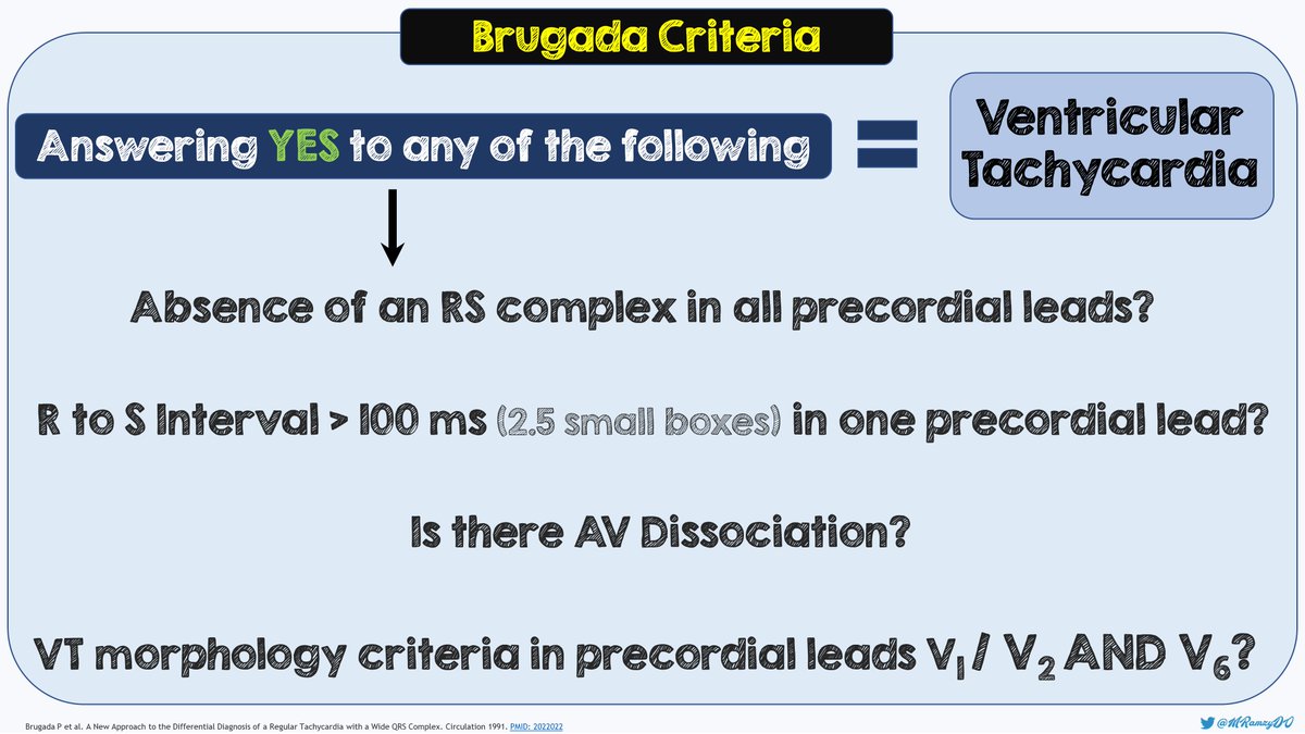 Another critical clinical distinction that needs to be made is differentiating V-Tach from SVT w/Aberrancy. One can use Brugada’s criteria to help better identify VT #FOAMed  @HumanFact0rz  @DogICUma  @EBMgoneWILD  @claski  @KristinJBoyle  @Rothy001  @SorenRudolph  @AndrewTabner