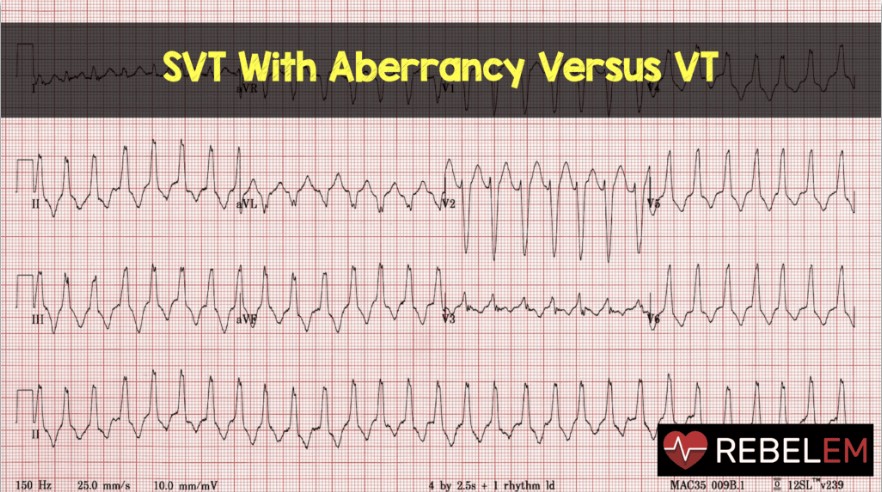 REBEL EM has a great post about differentiating VT from SVT w/Aberrancy found here: https://rebelem.com/svt-aberrancy-versus-vt/ via  @srrezaie &  @EMSwami So 2nd take away point: Use Brugada’s Criteria to help differentiate VT from SVT w/Aberrancy!