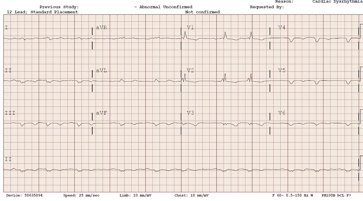 Following failed AICD overdrive pacing, 100 mg of Procainamide was given over 2 minutes four times before being placed on a procainamide gtt. He reported feeling better after the boluses and here’s his EKG: #FOAMed  #CardioTwitter  @EricLeeMD  @DuncanGrossman  @AllNYCEM  @FalconERDoc