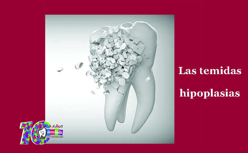 Dentikids's tweet photo. No todas las manchas son hipoplasias o problemas de esmalte. 

Entérate aquí: https://t.co/XMzWSrMNiy

#dientesdeleche  #dentistaadultos  #padresehijos https://t.co/4W8TN3VhPM