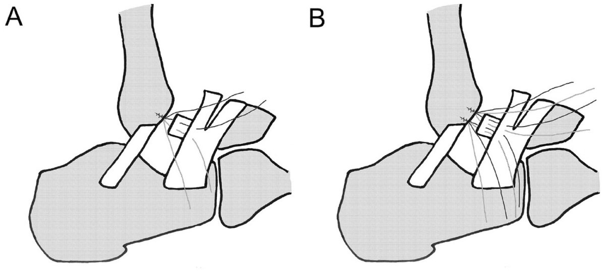 AOFAS_Journals's tweet image. Treatment of chronic lateral ankle instability with the all-inside arthroscopic Brostrom-Gould surgery yields better functional outcomes and recovery to preinjury mobility when 2 anchors are used instead of 1. ow.ly/1Ben50AkS89
