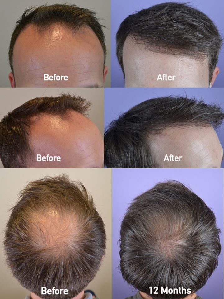 Nicole E Rogers, MD on Twitter: "FUE hair transplant combined with therapy radically changed this gentleman's look! #fuetransplant #fuetransplantation #hairtransplantsurgery #hairtransplantsurgerybeforeafter #minoxidil ...