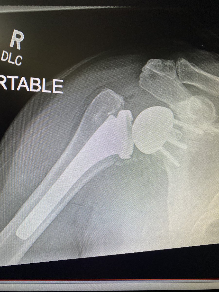 Kevin J. Cronin MD (@kevincroninmd) on Twitter photo Last day of residency today, couldn’t think of a more fitting case to go out with! Loose glenoid converted to rTSA. Thank you to my mentors <a href="/smair2/">Scott Mair</a> <a href="/darrenjohnsonmd/">darrenjohnsonmd</a> <a href="/KavehSajadi/">Kaveh Sajadi, MD, FAAOS</a> <a href="/CarolynHettrich/">Carolyn Hettrich MD MPH FAOA</a>... on to fellowship! Last day of residency today, couldn’t think of a more fitting case to go out with! Loose glenoid converted to rTSA. Thank you to my mentors <a href="/smair2/">Scott Mair</a> <a href="/darrenjohnsonmd/">darrenjohnsonmd</a> <a href="/KavehSajadi/">Kaveh Sajadi, MD, FAAOS</a> <a href="/CarolynHettrich/">Carolyn Hettrich MD MPH FAOA</a>... on to fellowship!