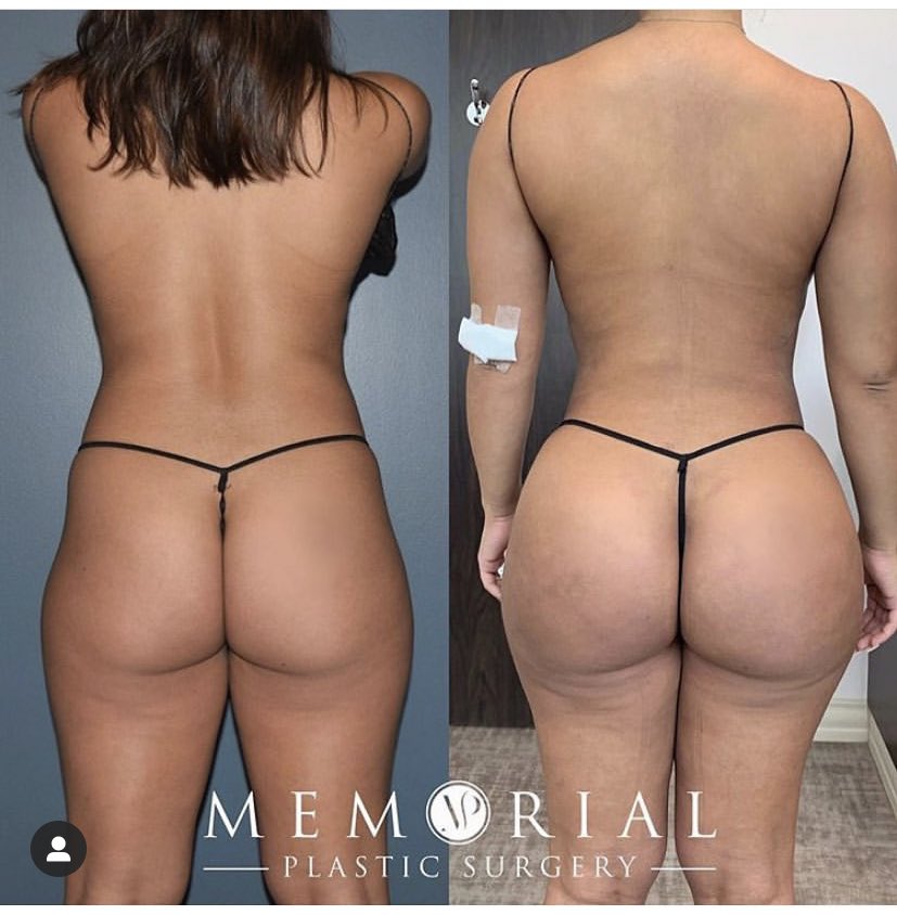PLASTIC SURGERY CONSULTANT on X: Slim thick BBL examples