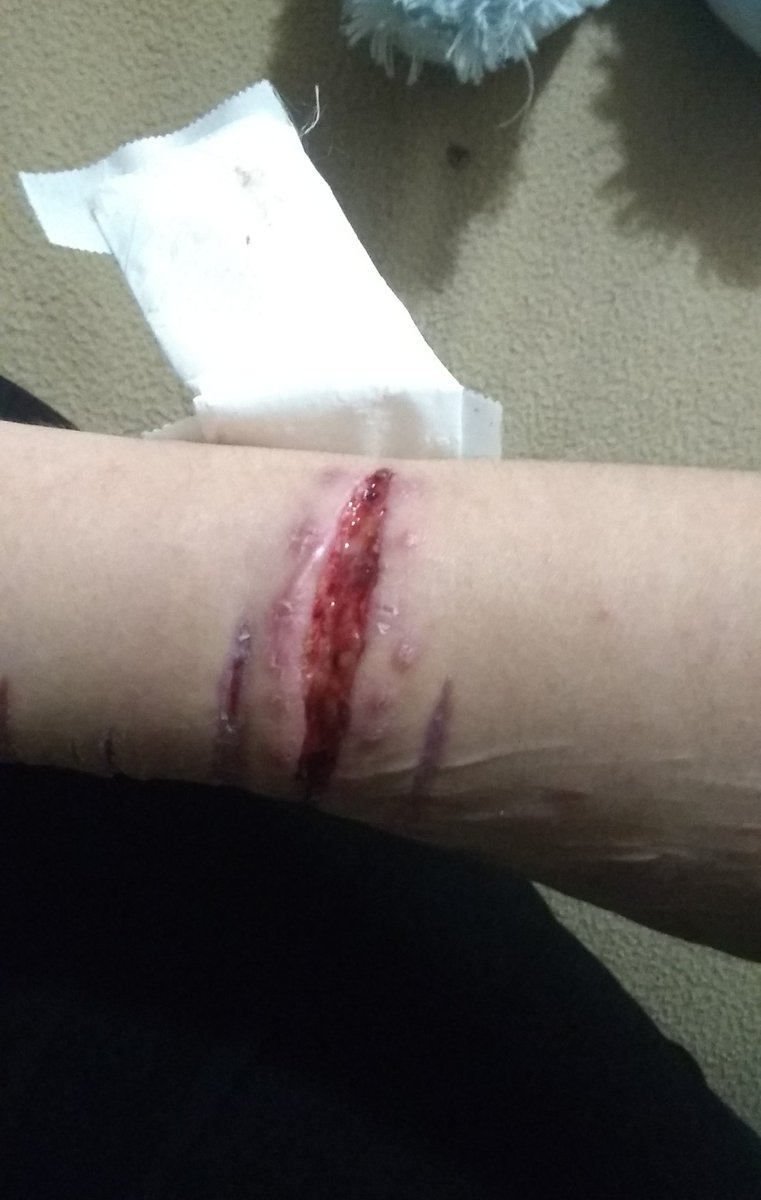Babi_gore's tweet photo. This one was a fun one,,,, i have the video somewhere
#proselfharm #selfharmtwt https://t.co/E5z3TctmjD