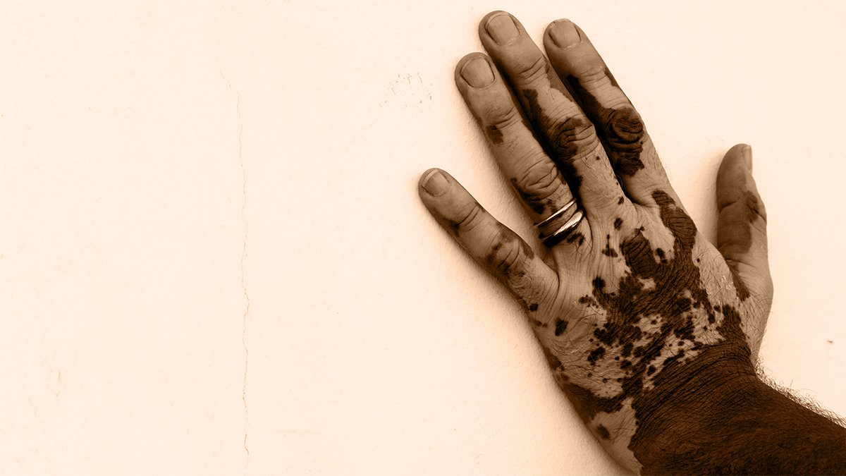 prioritesante's tweet image. Le #vitiligo est une #maladie chronique de l&apos;épiderme, caractérisée par une #dépigmentation et l&apos;apparition de taches blanches sur plusieurs zones du #corps . Cette pathologie touche 0,5 à 1% de la population mondiale. RDV à 9h10 TU sur @RFI