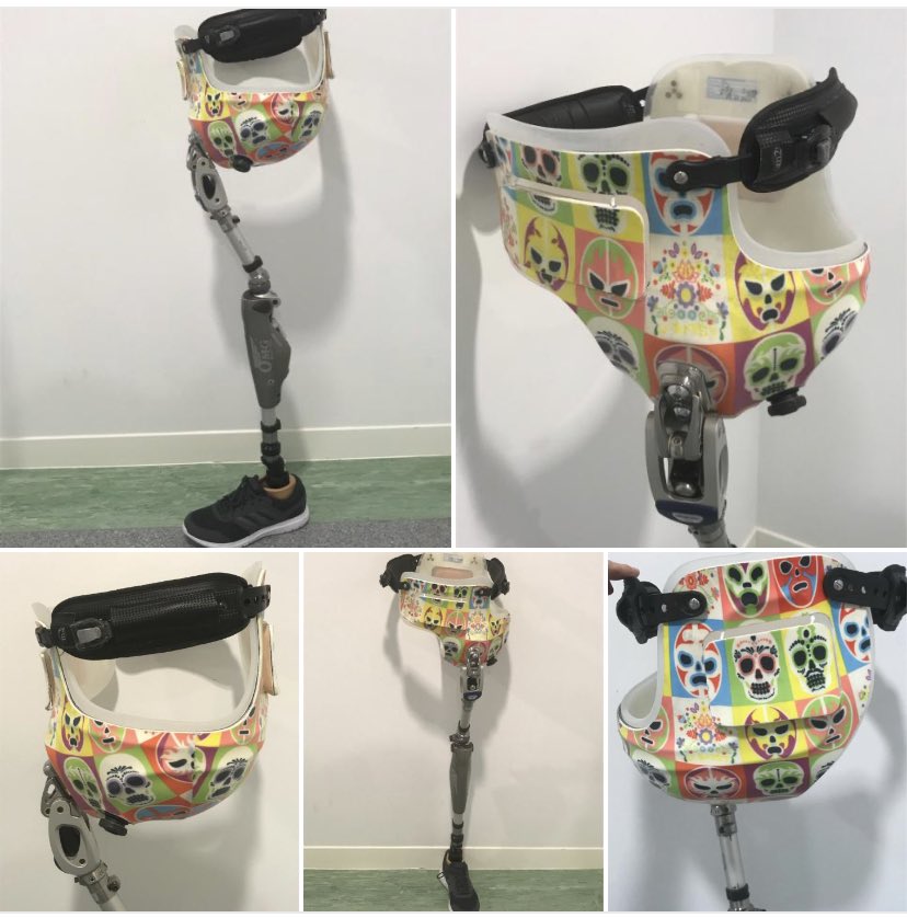 basuthegreat's tweet image. #specialisedAbilityCentre Manchester and Sarah Kirkwood - The team really pulled this one out of the bag!Ottobock 7E9 hydrolic hip joint and C-Leg 4 really are an awesome combination #opcare #SACM 👏