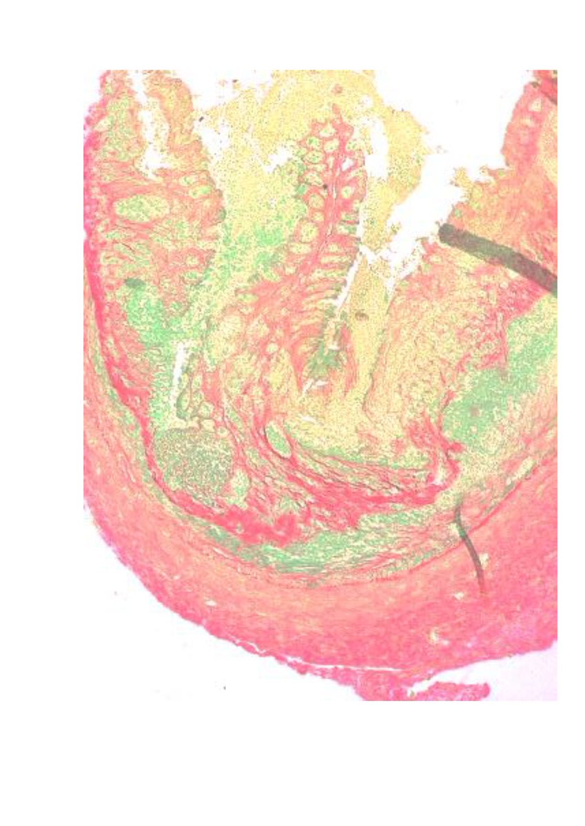 pharmacologyvlc's tweet photo. Our new article in J Steroid Biochem Mol Biol: THE VITAMIN D RECEPTOR TAQ I POLYMORPHISM IS ASSOCIATED WITH REDUCED VDR AND INCREASED PDIA3 PROTEIN LEVELS IN HUMAN INTESTINAL FIBROBLASTS. #crohns #PDIA3 #TaqI #VDR #fibroblast #polymorphism #vitaminD @CIBERehd @GVAfisabio @UV_EG https://t.co/oPnkEajBAC
