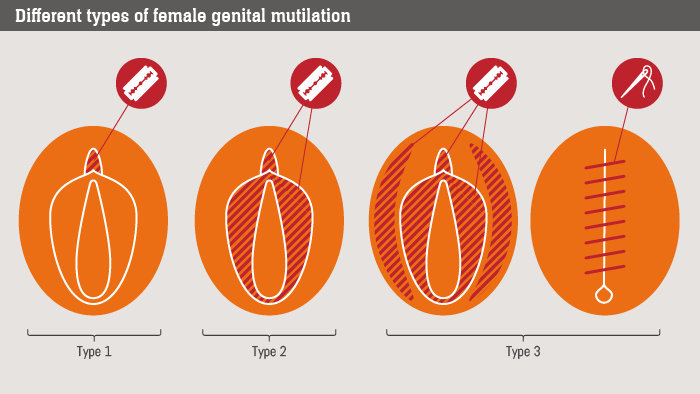 There are different types of FGM.Some people also remove/ shrink the labias- this is done esp to create 'fine vagina' Type 1 and type 2 are popular.In some cultures- they do the opposite and stretch the labia - that's called FGM type4.