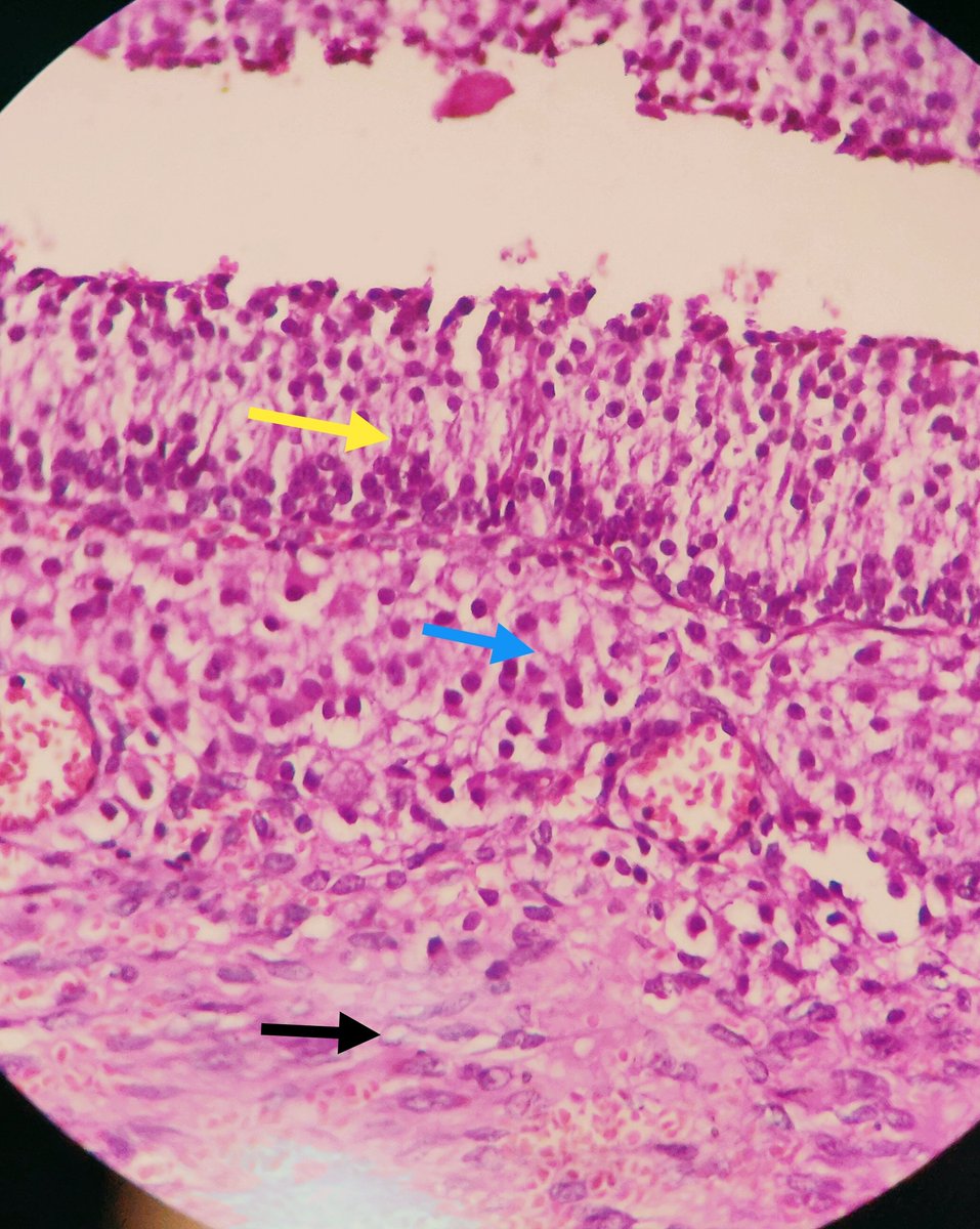 pratishtha_07's tweet image. For the PGY1s in Pathology..
#gynpath #histology #PGY1 #OVARY  #normalhistology 

Image1- mature graffian follicle
Image2- Yellow: Granulosa layer
                Blue: Theca interna
                Black: Theca externa