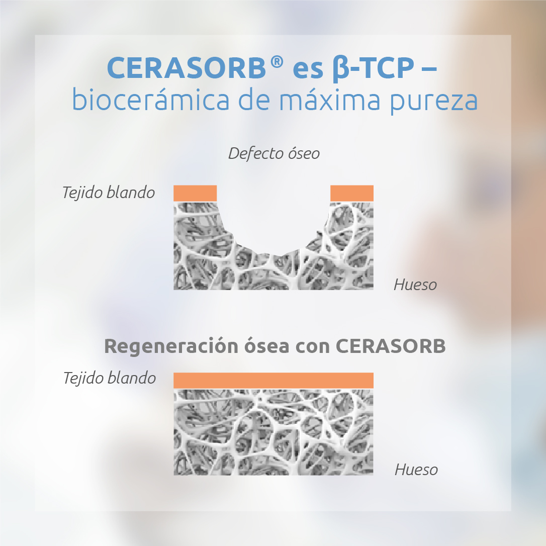 EckermannLab's tweet photo. Conoces Eckermann 360º, pero hoy te presentamos La mejor solución para la regeneración ósea, CERASORB. 

Conoce todo sobre la biocerámica más pura:
https://t.co/AlekYqEste

#eckermann #impantes #implantologia #bioceramica #cirugia #boca #bucal #dientes #encias #odontologia #oseo https://t.co/62ifZRMTZt