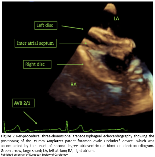 European Society of Cardiology Journals (@esc_journals) on Twitter photo Temporary complete heart block during PFO closure bit.ly/3dI5oSj
#radialfirst #EPpeeps #cardiotwitter #EHJCaseReports <a href="/johncamm/">Mohammed Ali</a> Temporary complete heart block during PFO closure bit.ly/3dI5oSj
#radialfirst #EPpeeps #cardiotwitter #EHJCaseReports <a href="/johncamm/">Mohammed Ali</a>