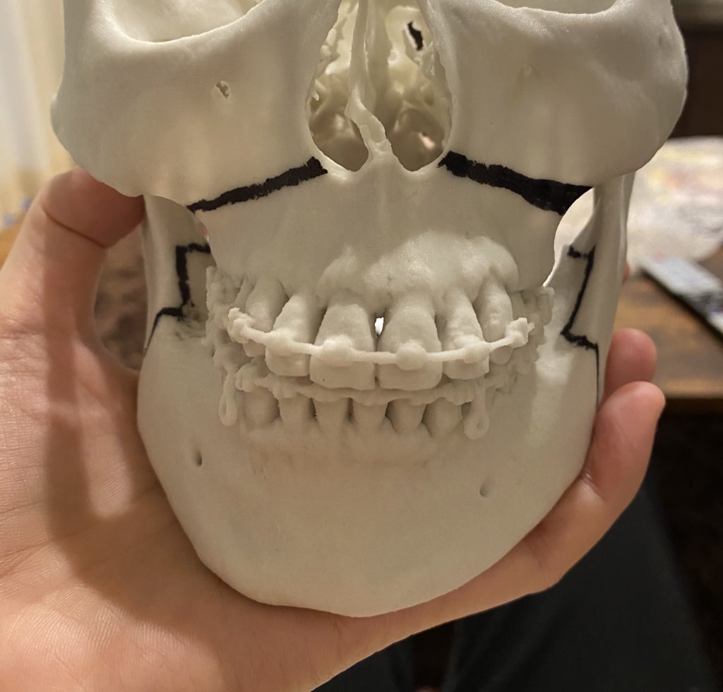 白猫 顎変形症5 21手術済 Shiro Twitter