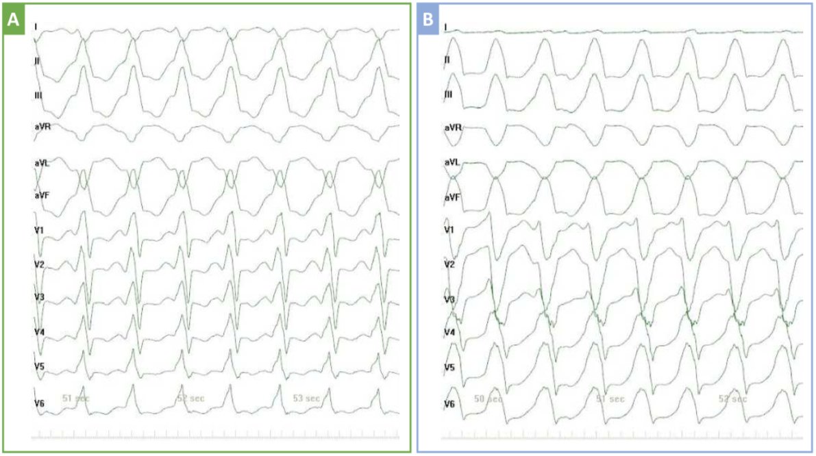 Finally on-line! We present feasibility, safety, and effectiveness of Bipolar RF for VT originating from IVS. The outcome is excellent: 95% of patients met the primary endpoint of non-inducibility of the target clinical VT. 
#ablateVT @EPeeps_Bot bit.ly/2YIMkiz