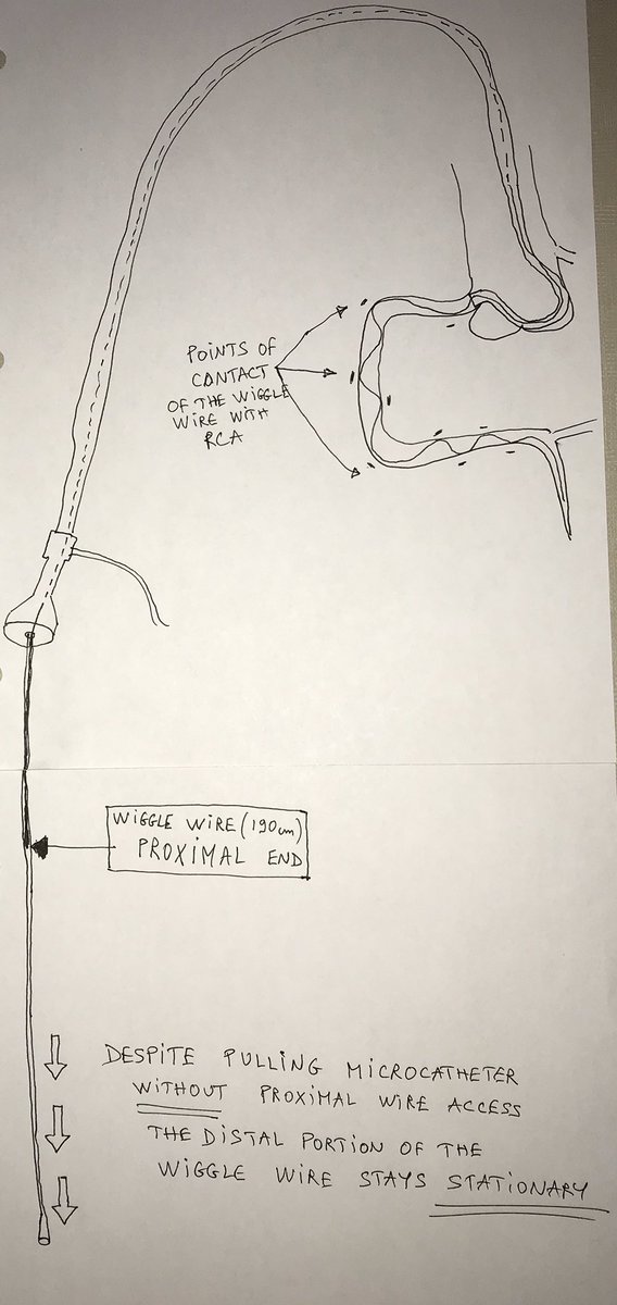 HadyLichaaMD's tweet image. #Cathlabhack-Another advantage of the #Wiggle #wire for #radialists: No more need for long wires to exchange, Just pull out MC &amp;amp; short wiggle doesn’t move #ACCIC #cardiotwitter 

@nickaram @Allison_Dupont @kerrigjl @Pooh_Velagapudi @RajTayalMD @DLBHATTMD @lorenzo2509 @DrJayMohan