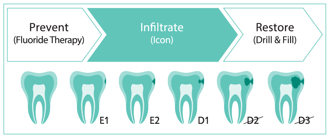 Did you know that caries that have progressed up to the first third of the dentin (D1) can still be treated with Icon? Icon can block the progression of an early caries to prevent the need for drilling and filling. Call us to chat about Icon. #IconbyDMG
https://t.co/pa7goFdW71 https://t.co/cxPGvIaZCc