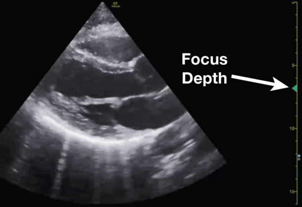 (18) Step 7: Optimize the Focus. The last ultrasound setting you can use to optimize your image is by adjusting the focus. Focus concentrates your ultrasound waves at a specific depth of the image to maximize the resolution at that depth. https://pocus101.com/knobology 