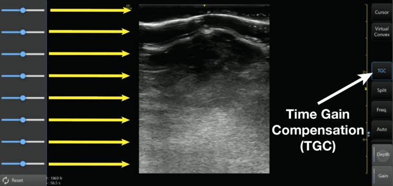 (17) Step 6: Optimize Time Gain Compensation (TGC).Adjusting the TGC allows you to adjust the gain at almost any depth of your ultrasound image The top rows control the nearfield gain and the bottom rows control the far-field gain. https://pocus101.com/knobology 