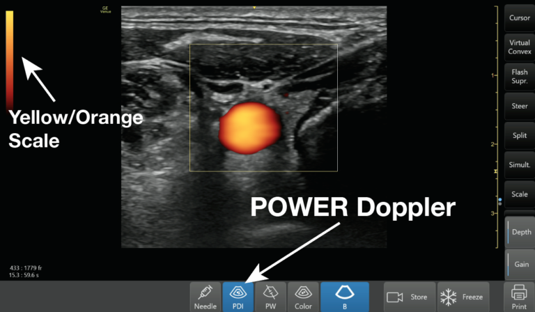 (23) Power Doppler shows up as yellow/orange color signifying the amplitude of flow. It is more sensitive than color Doppler and is used to detect low flow states such as venous flow in the thyroid or testicles. https://pocus101.com/knobology 