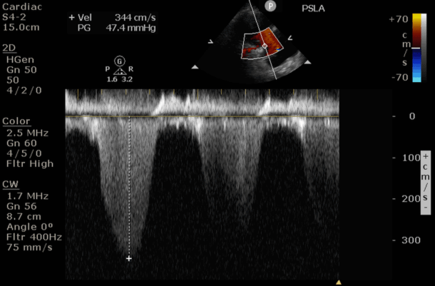 (25) Continuous Wave Doppler is very similar to pulse wave Doppler except it does not alias and can detect very high velocities (> 1000cm/second).CW is the optimal choice for high-velocity applications such as valvular stenosis and regurgitation. https://pocus101.com/knobology 