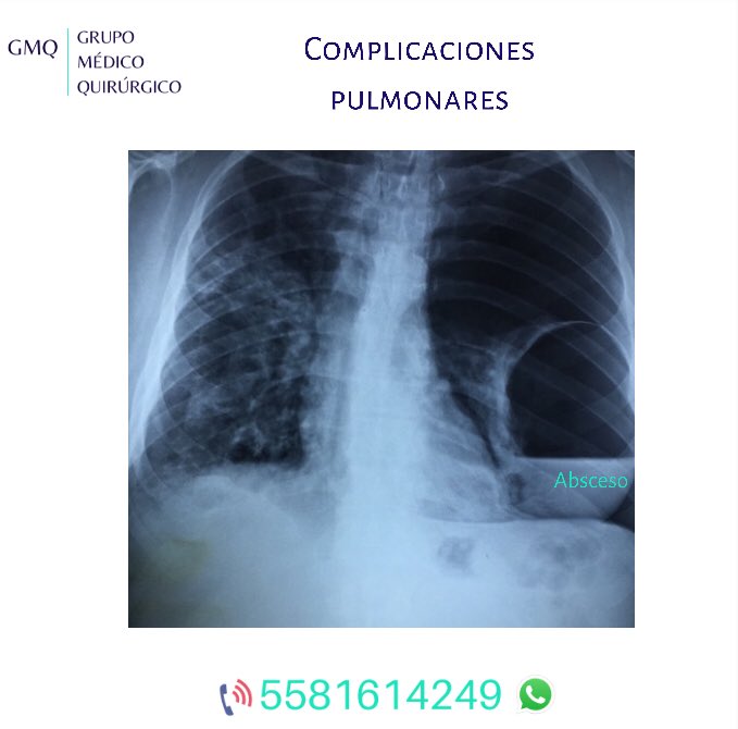 GMQ23's tweet photo. Algunos “derrames” no necesitan una sonda endopleural. Un absceso pulmonar #seopera #ciruGMQ #cirugía #covid19 #neumonia #coinfección #abscesopulmonar #GMQ https://t.co/X0p24mhN4g