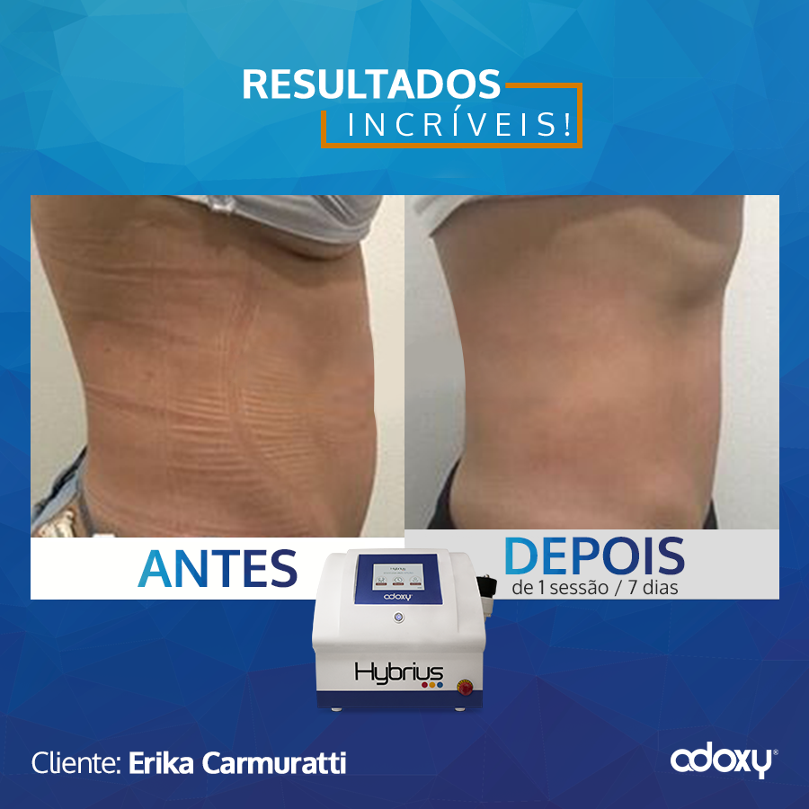 Adoxy on X: "Sabe aqueles resultados que você olha nas redes sociais e fala: não é possível?! Isso só pode ser montagem! Nossos clientes passam por isso, mas com resultados verdadeiros... #adoxy #