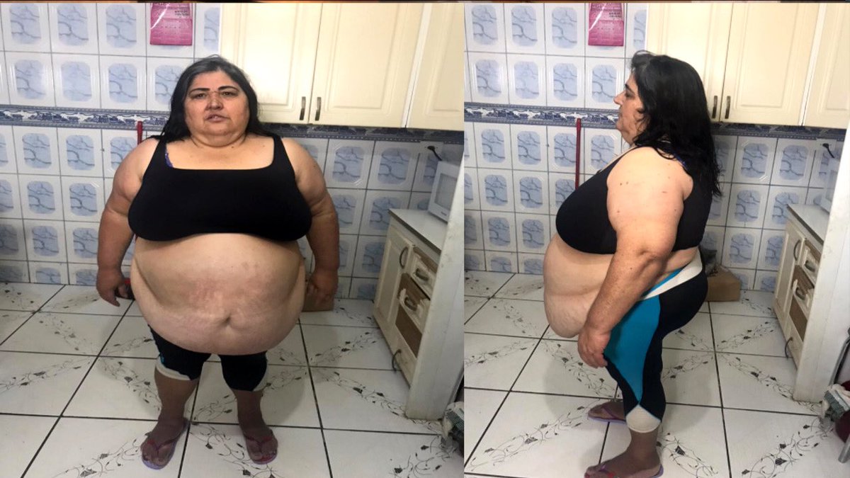 caosdoues's tweet photo. Preciso da ajuda de vcs. Minha sogra tem um problema muito grave de obesidade e por conta do peso ela está com o coração inchado. Necessitamos urgentemente fazer uma cirurgia bariátrica e por isso decidimos fazer essa vakinha on-line. #COMPARTILHEM PFVR 
https://t.co/Olt2OBR5jy… https://t.co/J4rVTPXC2t