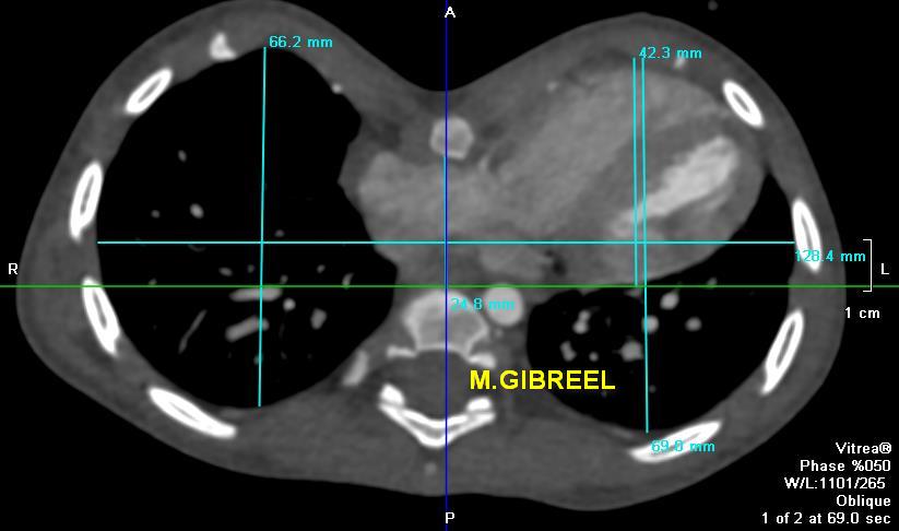 MGibreel1's tweet image. Pectus excavatum ,,, what to u need to be commented in your report ...
From my archieve
@AlkashkariWail
